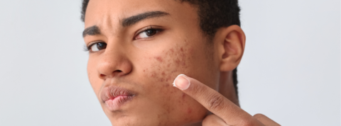 Acne Awareness Month: Why Acne Happens and What You Can Do About It