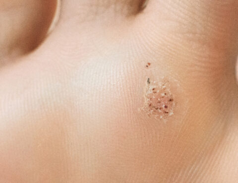 Understanding verrucas – treatment options and strategies for effective removal