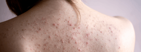 Understanding Roaccutane Treatment: A Positive Approach with Oxona Health