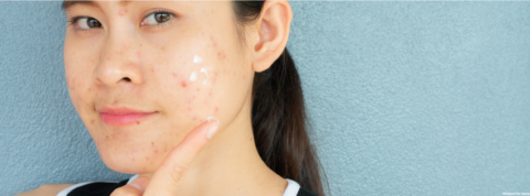 Winlevi: A New Era in Acne Treatment