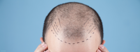 Hair Transplants & Advanced Hair Restoration in St Albans